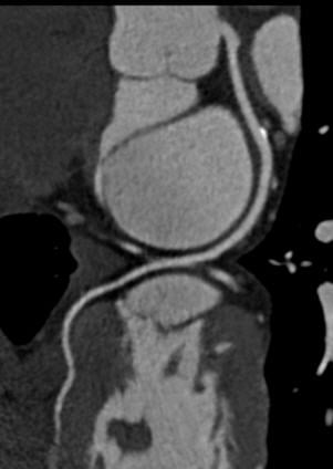 CT May Reduce Costs in Evaluating Chest Pain Imaging Technology News